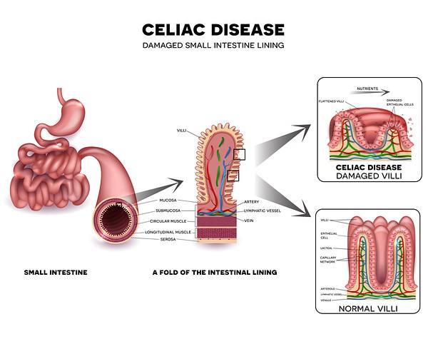 Celiac damage