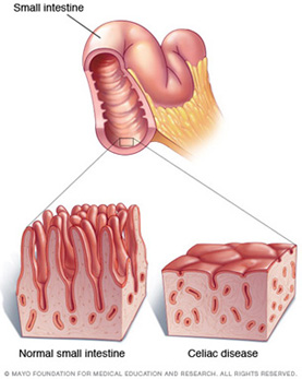Celiac small intestine